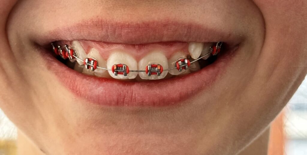 Brackets en niños.